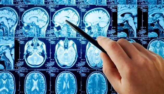 Мозкові інсульти: які медичні заклади Херсонщини надають безоплатну допомогу? 